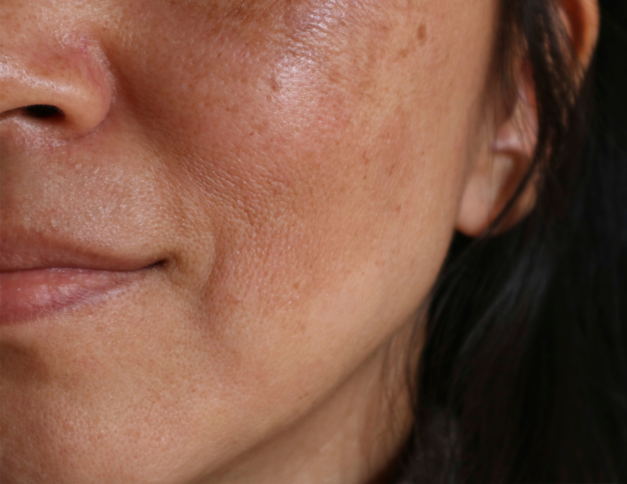 Stippe Intro to brown spots & treatment – ANATO
